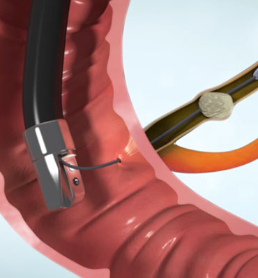 Endoscopic Retrograde Cholangiopancreatography